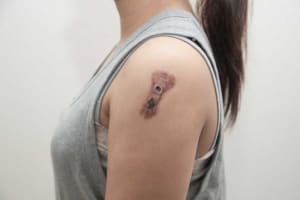 melanoma